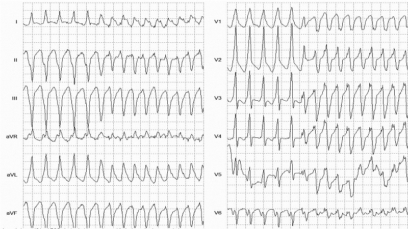 Torsades DePointes 12 Lead EKG